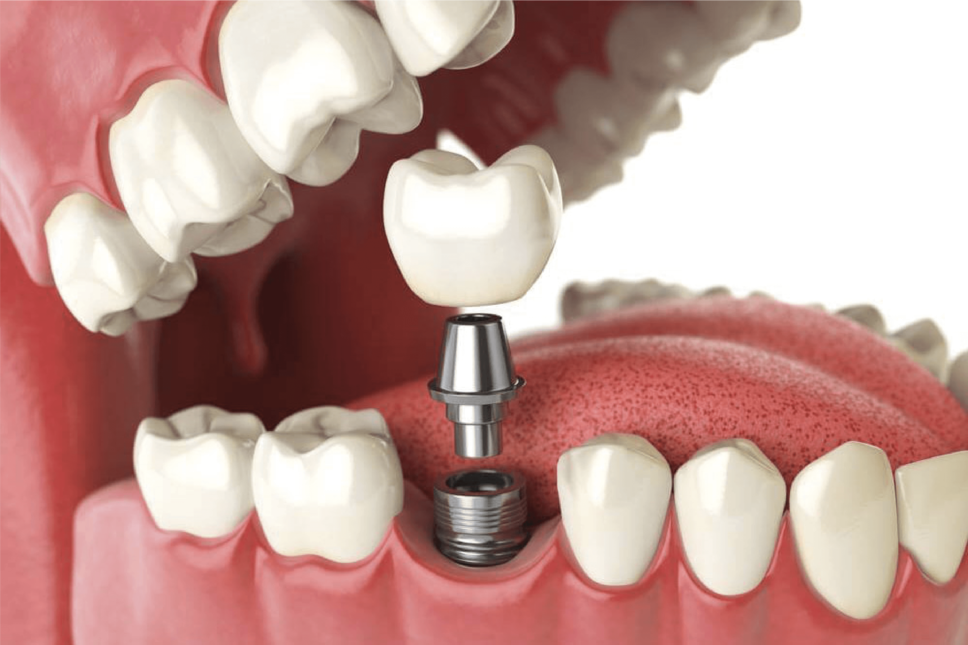 Rendrd 3d, bocca con impianto dentale. Implantologia- Mantua Dental Institute
